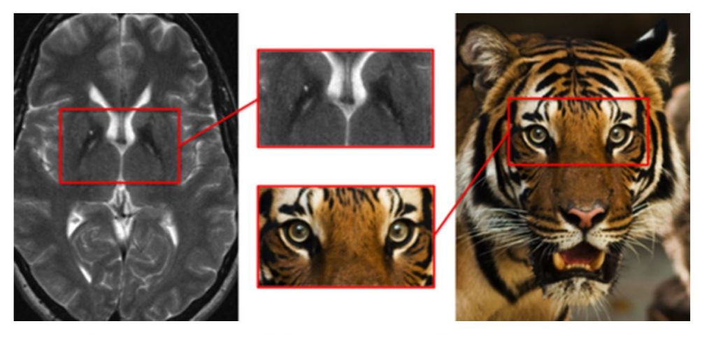 Симптом глаз тигра на мрт