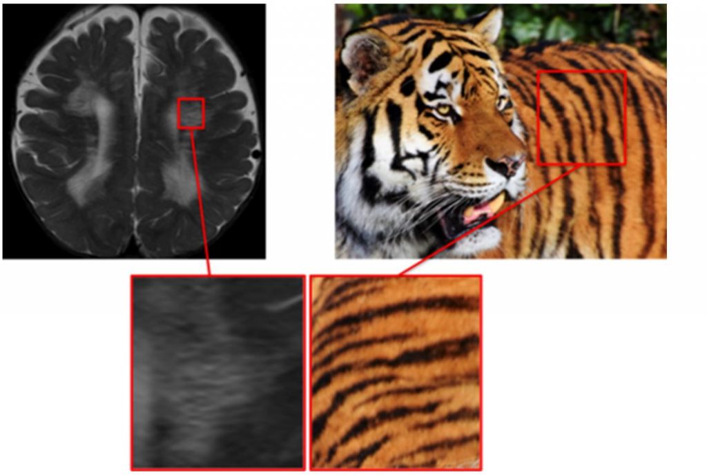 Симптом глаза тигра на мрт